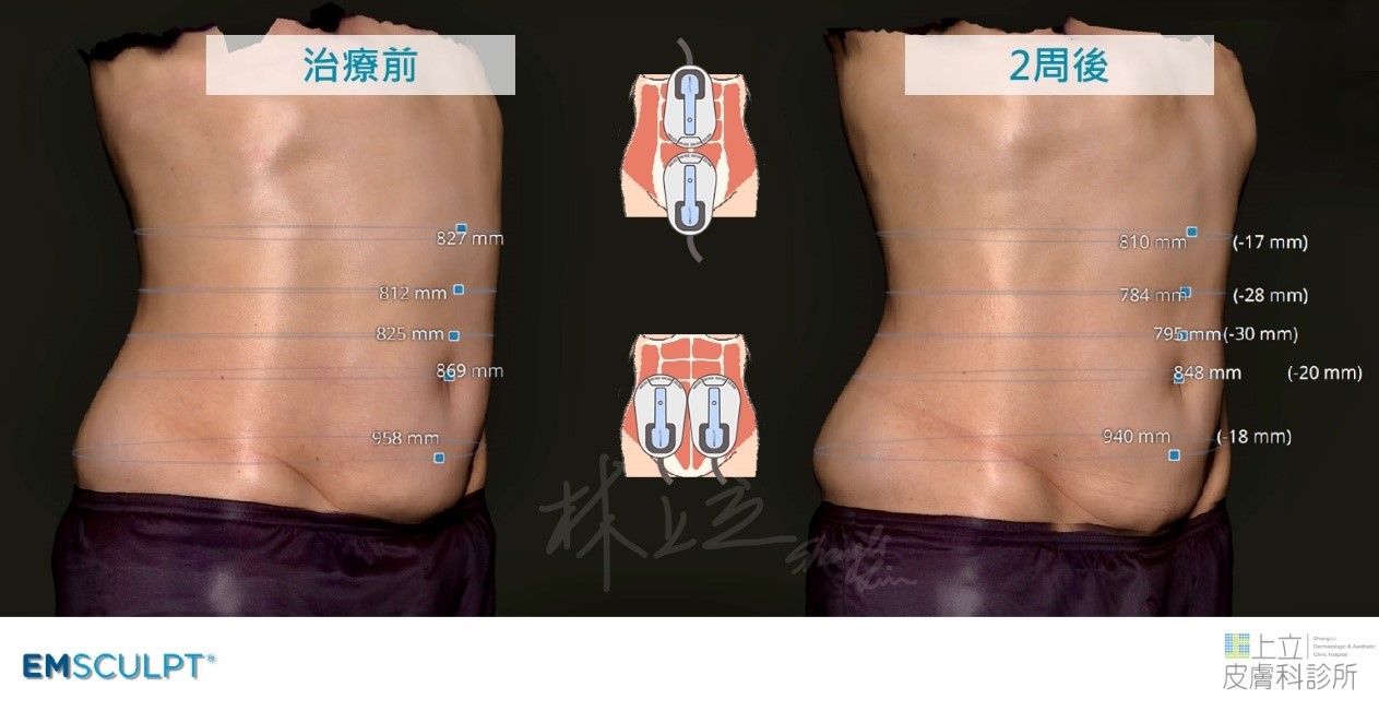 EMSCULPT肌動減脂的探頭強化兩側腰部線條，同時使下腹部變小