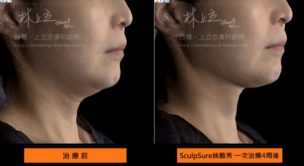SculpSure熱塑溶脂（絲酷秀體外雷射溶脂）雙下巴除了可以破壞下巴區域部位的脂肪