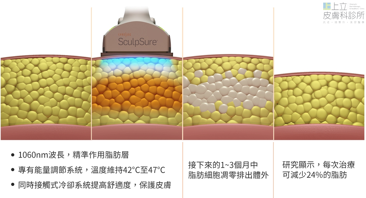 SculpSure熱塑溶脂（絲酷秀）作用原理