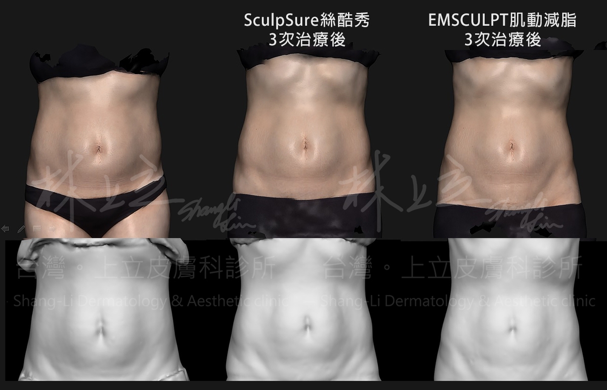 以SculpSure熱塑溶脂（絲酷秀）減少腹部脂肪
