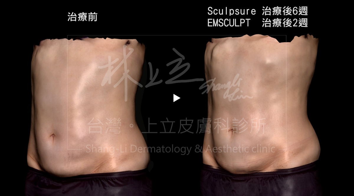 合併SculpSure熱塑溶脂（絲酷秀）和EMSCULPT肌動減脂來治療，同步減脂和雕塑腹部線條