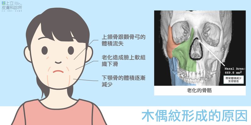 木偶紋的形成原因牽涉到整個中上臉的骨架流失，以及軟組織位移、往下滑落。