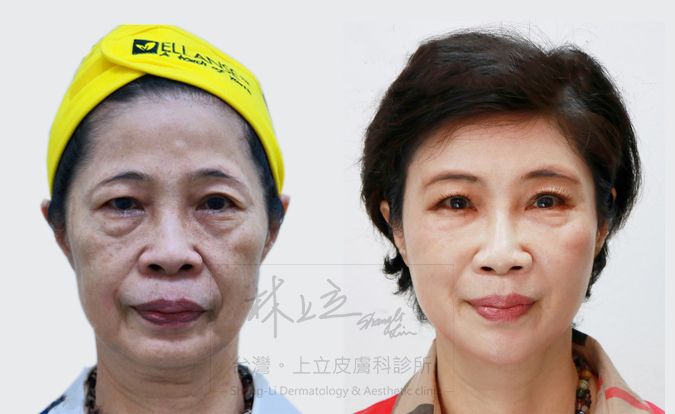 治療木偶紋時,不能只是去填補下巴,應該要同步把中臉的問題一起解決了,木偶紋自然也會跟著改善許多,甚至在視覺上還有拉長下巴比例的效果。