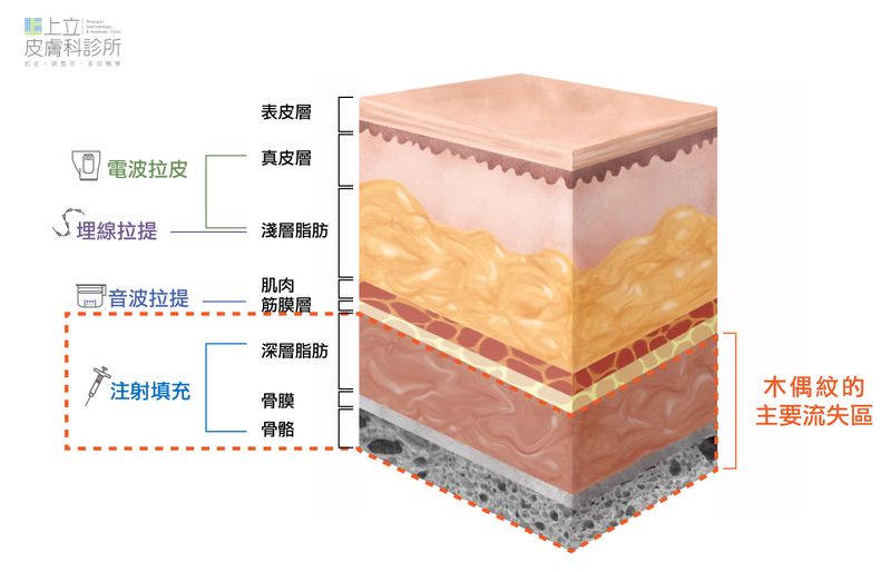 不論是電音波或埋線的作用層次都比較淺,對於木偶紋的改善幫助不大。